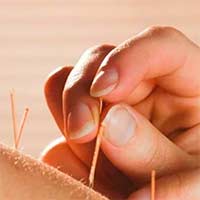 Acupuncture