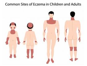 Eczma