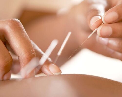 Toyahari acupuncture Brisbane